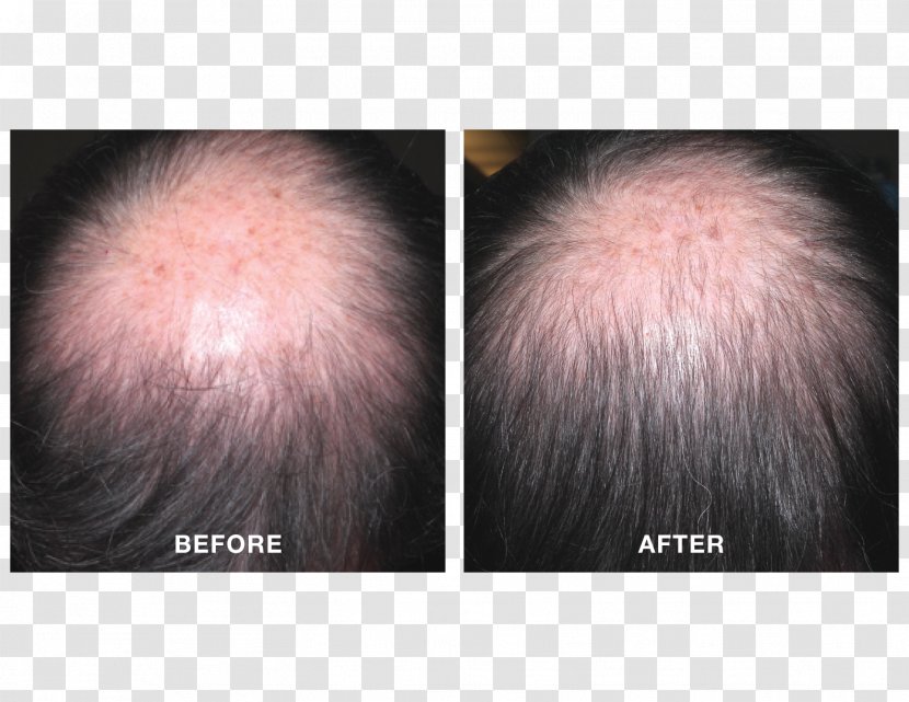 Minoxidil Management Of Hair Loss Platelet-rich Plasma Finasteride - Tree Transparent PNG