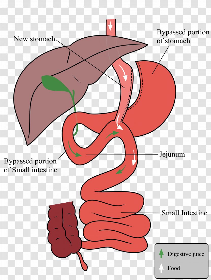 Sleeve Gastrectomy Gastric Bypass Surgery Duodenal Switch Bariatric - Tree - Cartoon Transparent PNG
