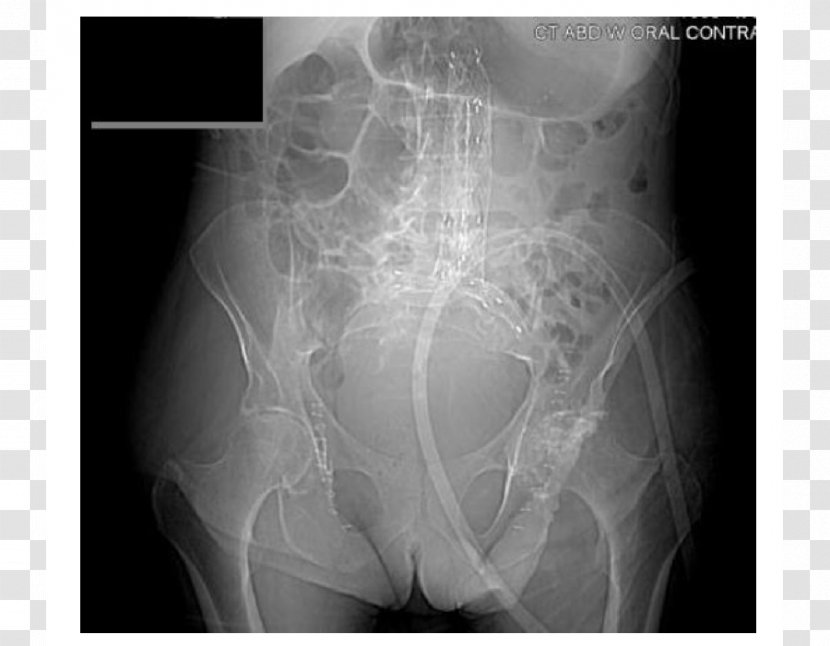 Abdominal Aortic Aneurysm Endovascular Repair Abdomen Surgery - Medical Imaging Transparent PNG