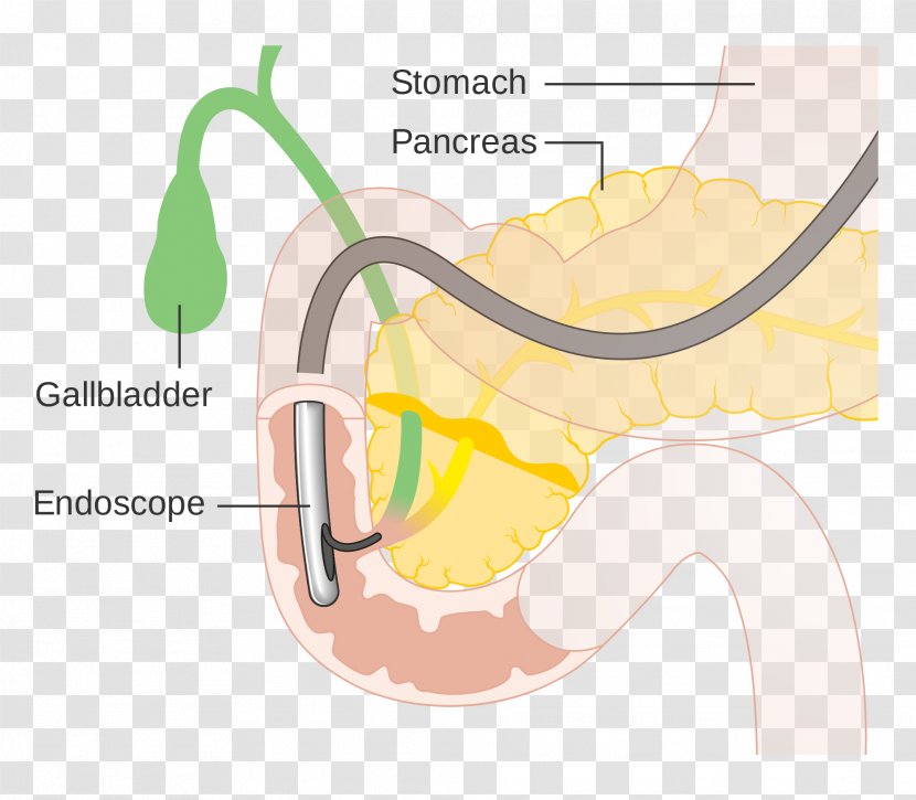 Endoscopic Retrograde Cholangiopancreatography Cholangiography Endoscopy Bile Duct Medical Procedure - Tree - Abdominal Pain Transparent PNG