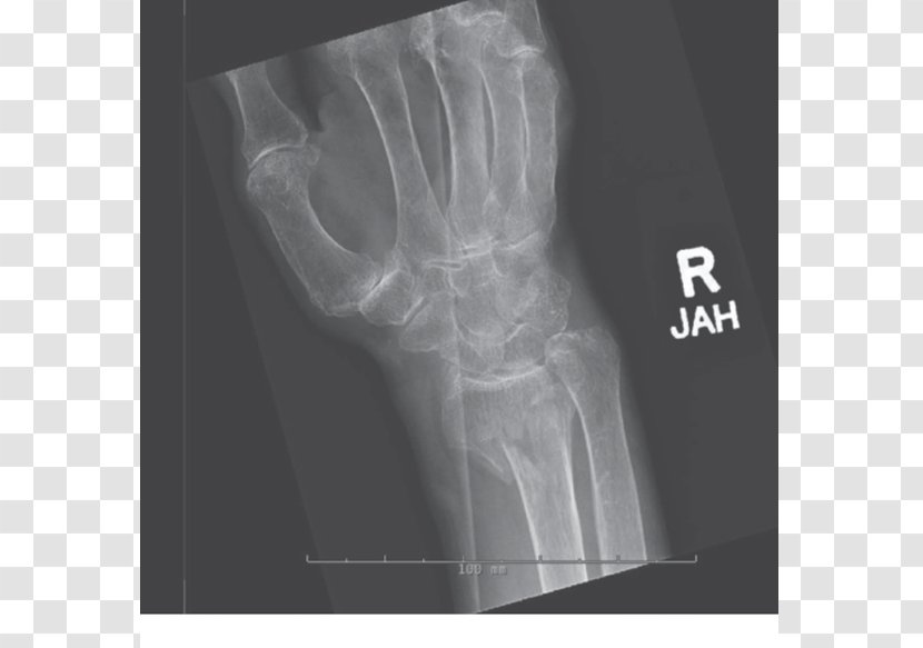 X-ray Bone Fracture Distal Radius Shoulder Arm - Radiology Transparent PNG