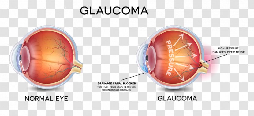 Glaucoma Vision Loss Eye Examination Care Professional - Human Transparent PNG
