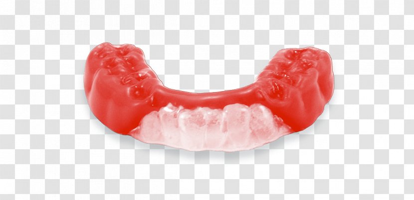 Mouthguard Tooth Athlete Sport Dentures - Concussion Transparent PNG