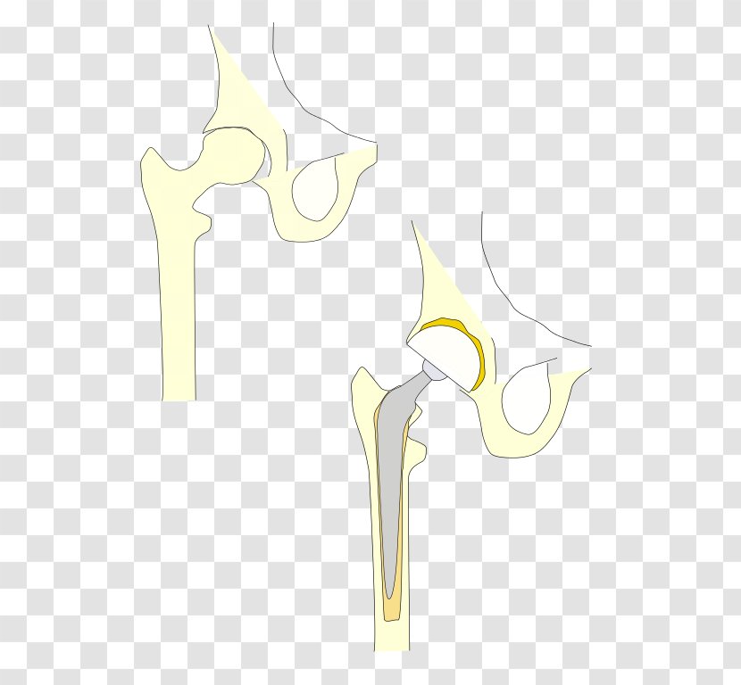 Hip Replacement Prosthesis Joint Pelvis - Heart - These Transparent PNG