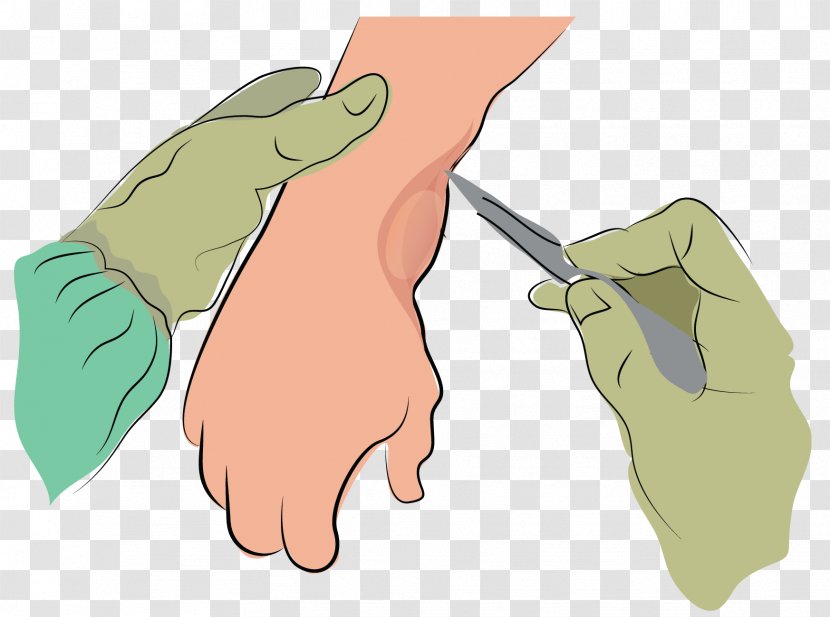 Synovial Cyst Finger Joint Fluid - Silhouette - Syringe Transparent PNG