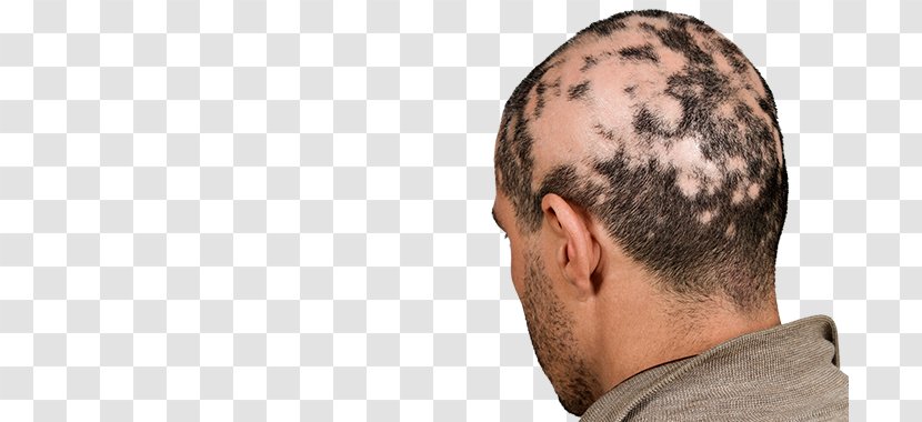 Alopecia Areata Non Scarring Hair Loss Pattern Transparent PNG