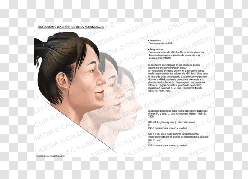 Acromegaly Diagnose Medical Diagnosis Symptom - Hearing - Nose Transparent PNG