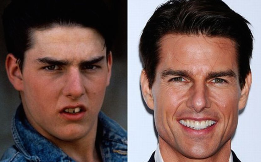 Tom Cruise Teeth Celebrity Dentistry Veneer - Film Transparent PNG