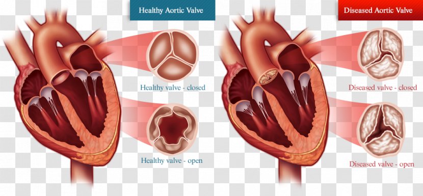 Valvular Aortic Stenosis Valve Replacement Heart Disease Balloon Valvuloplasty - Calculation Of Ideal Weight Transparent PNG