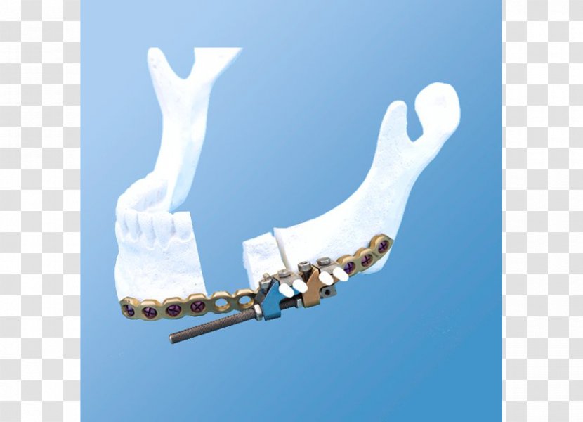 Mandible Distraction Osteogenesis Bone DePuy Synthes Companies - Multi Vector Transparent PNG