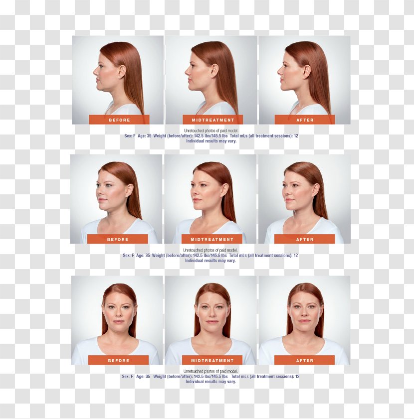 Deoxycholic Acid Face Surgery Chin Submental Triangle - Brown Hair Transparent PNG