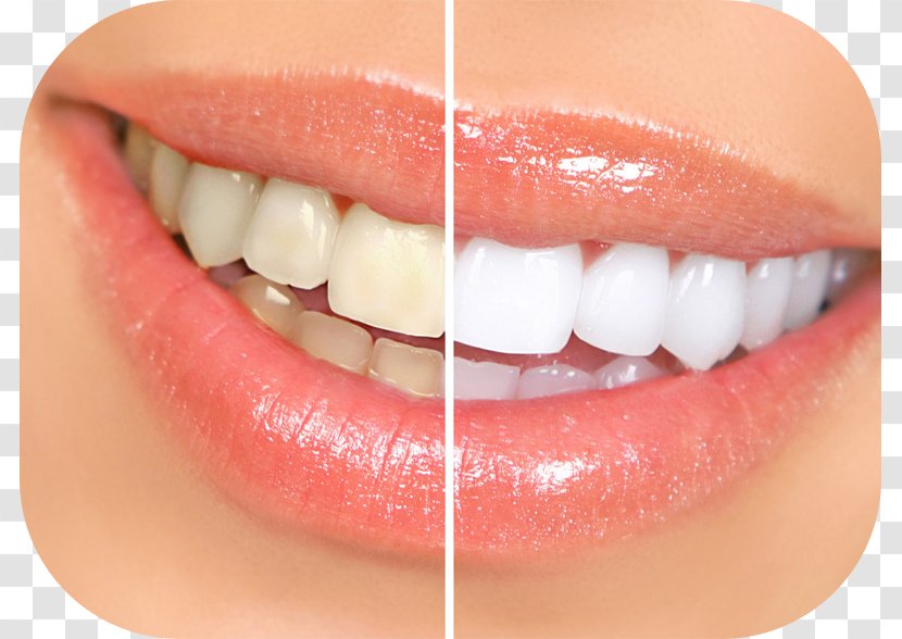 Tooth Whitening Dentistry Human - Lip - Dental Floss Transparent PNG