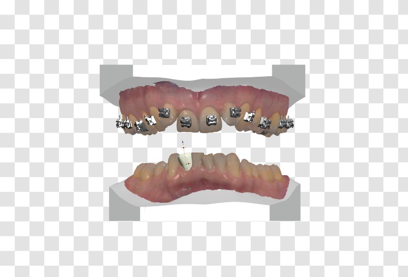 Tooth Dentures Prosthesis Computer-aided Design Computer Software - Dental Implant Transparent PNG