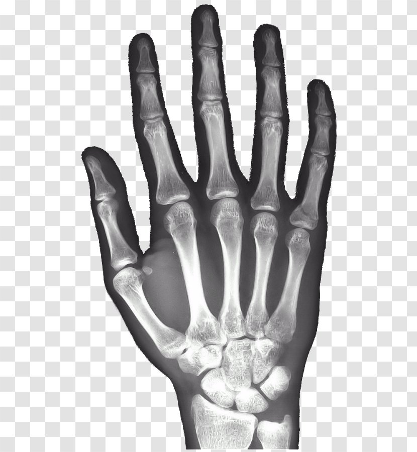 X-ray Hand Carpal Bones Android - Radiography - Rays Transparent PNG