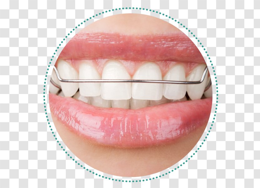 Orthodontics Dental Braces Dentistry Retainer Bridge Transparent PNG