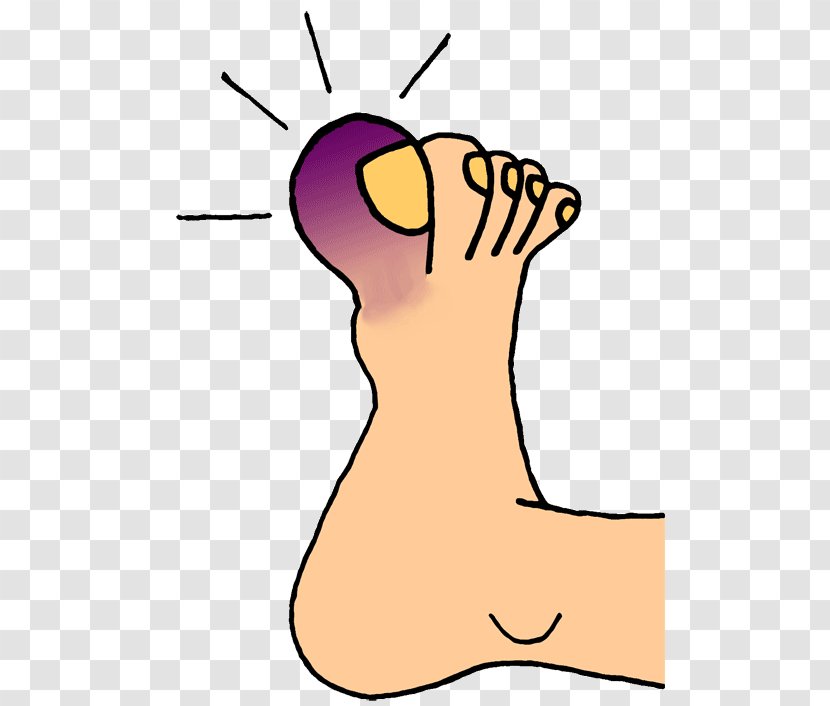 Toe Nail Foot Onychocryptosis Clip Art - Heart Transparent PNG