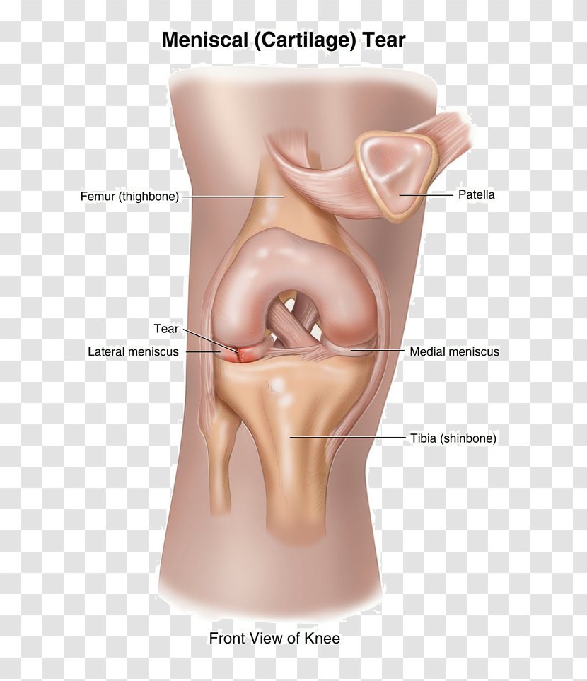 Tear Of Meniscus Knee Pain Ruptur - Tree - Flower Transparent PNG