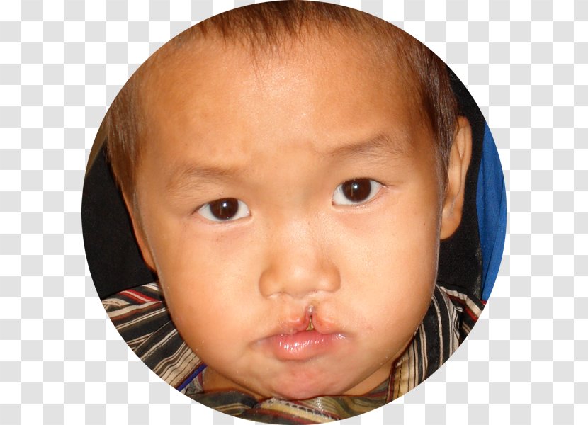 Cleft Lip And Palate Craniofacial Surgery - Surgeon Transparent PNG