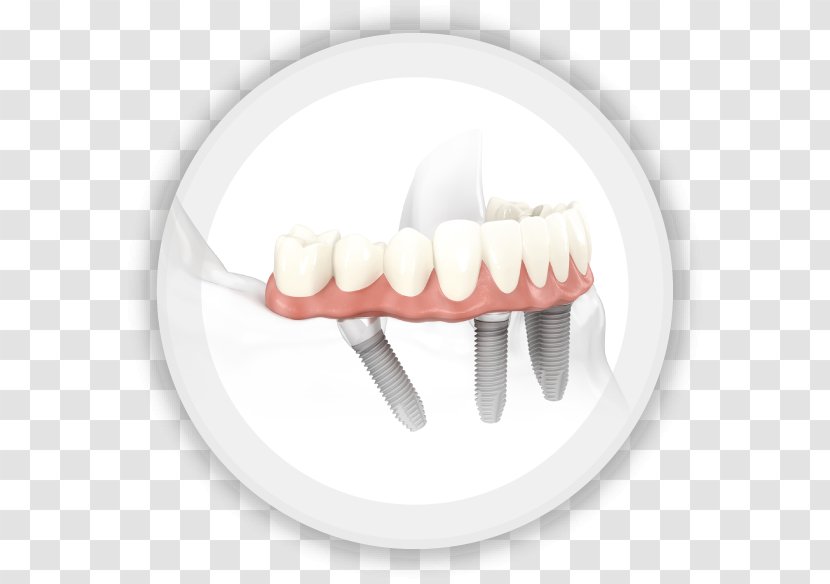 All-on-4 Dental Implant Dentistry Edentulism - Dentist - Bridge Transparent PNG