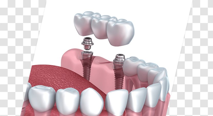 Dental Implant Cosmetic Dentistry Bridge - Cartoon Transparent PNG