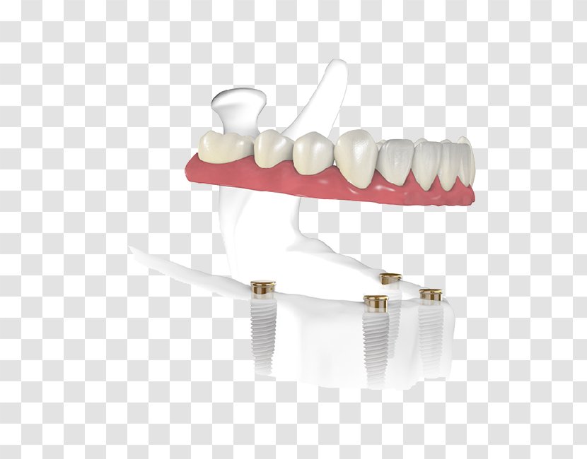 Tooth Dental Implant Dentist Edentulism - System - Material Transparent PNG