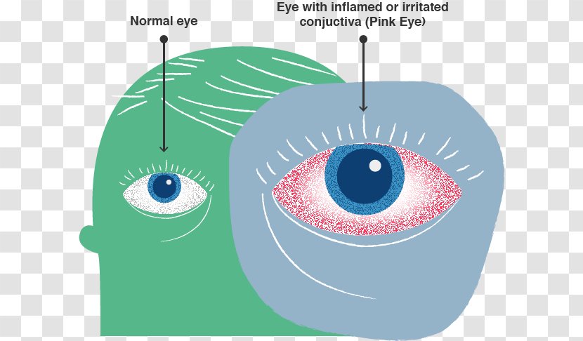 Eye Conjunctivitis Infection Health Medical Sign - Silhouette - Centers For Disease Control And Prevention Transparent PNG