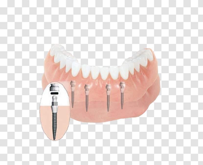 Tooth Dentures Dental Implant Dentistry - Health Transparent PNG