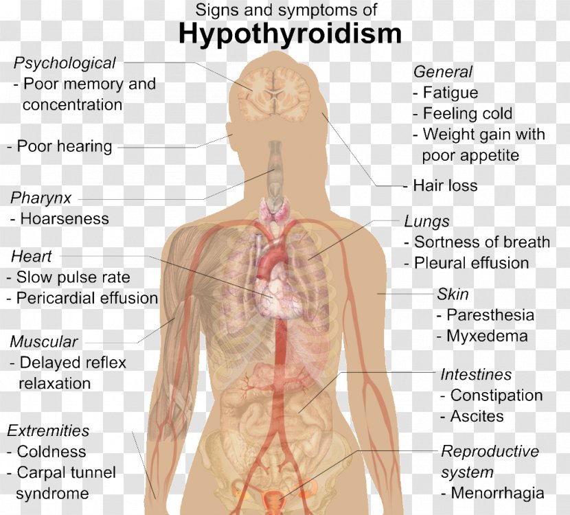 Hypothyroidism Thyroid Disease Medical Sign Levothyroxine - Cartoon - Gingival Bleeding Transparent PNG