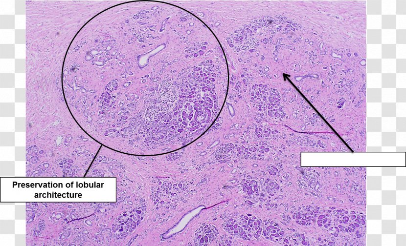 Pancreas Acute Pancreatitis Chronic Fat Necrosis - General Pathology - Pattern Card Transparent PNG