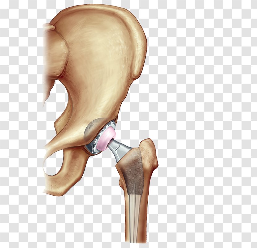 Hip Replacement Surgery Knee Joint - Trunk - Arthroscopy Transparent PNG