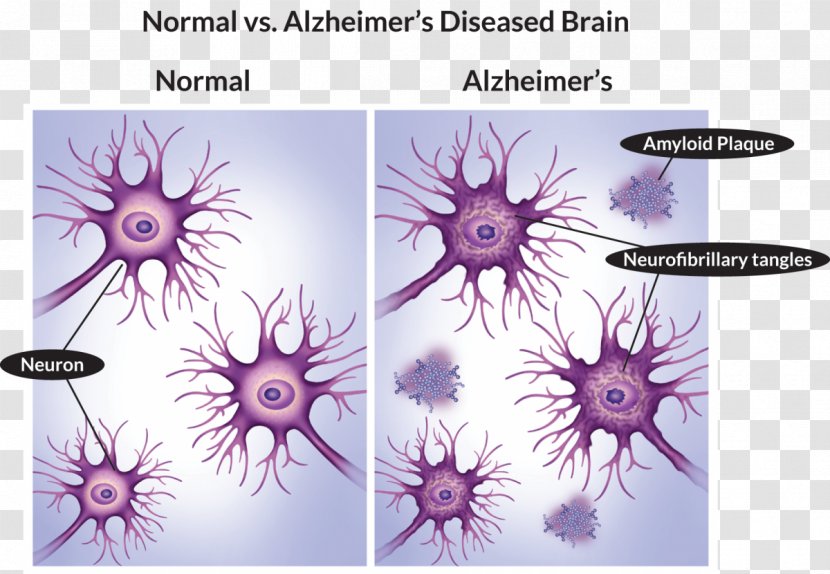Alzheimer's Disease Stock Photography Health Medicine - Memory - Alzheimers Transparent PNG