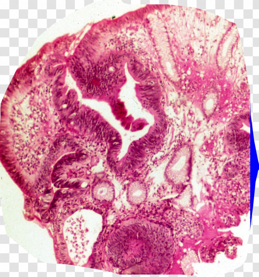 Organism Pink M - Tree - Gastrointestinal Stromal Tumor Transparent PNG