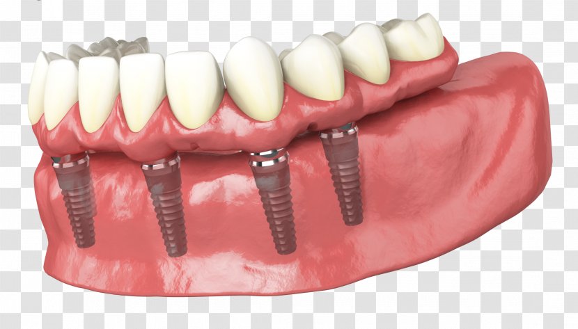 Tooth Dental Implant Dentures Dentistry - Human - Bridge Transparent PNG