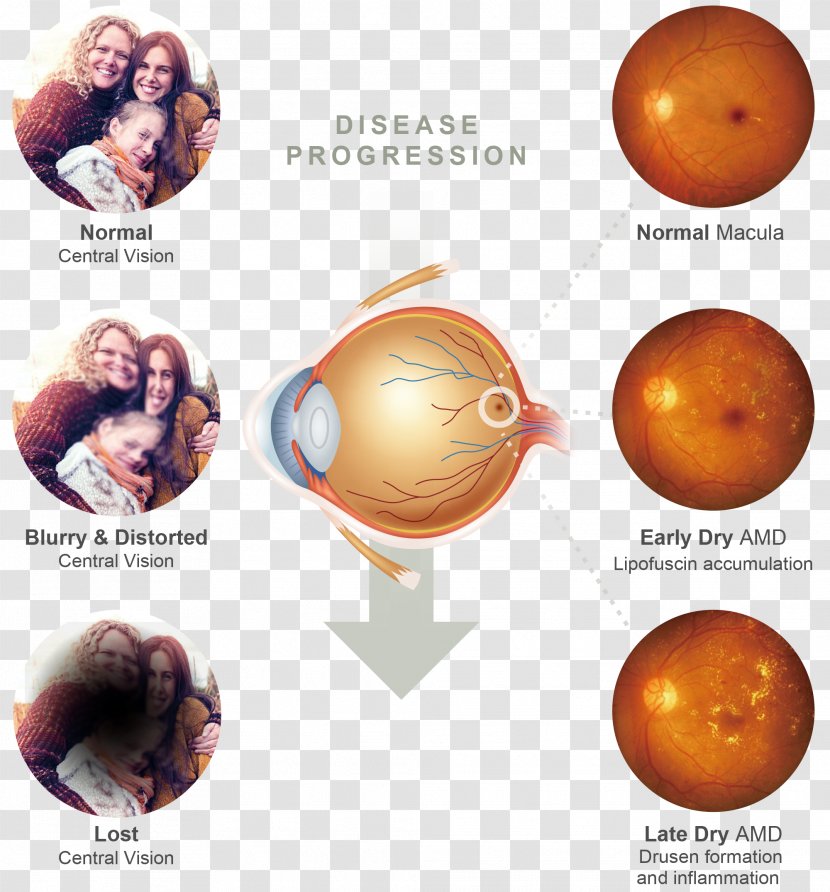 Macular Degeneration Macula Of Retina Stargardt Disease - Planet - Eye Transparent PNG