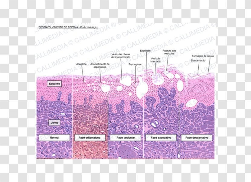 Histology Dermatitis Keratinocyte Microscope Slides Corte Histológico - Eqzema Transparent PNG