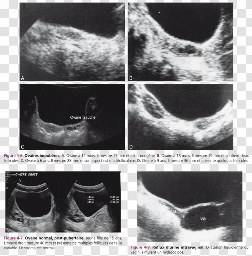 Ovary Gynecologic Ultrasonography Ovarian Follicle Cyst - Endometrium - VAGIN Transparent PNG
