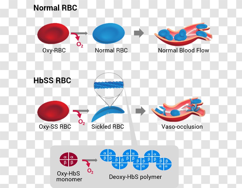 Sickle Cell Disease Hemoglobin Global Blood Therapeutics - Therapy Transparent PNG