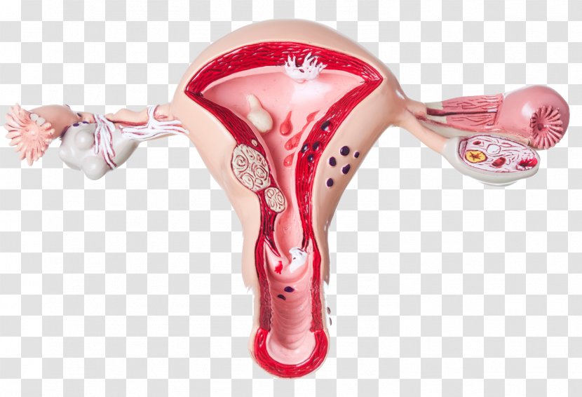 Ovary Ovarian Cyst Pain Uterus Symptom - Female Uterine Medical Model Transparent PNG