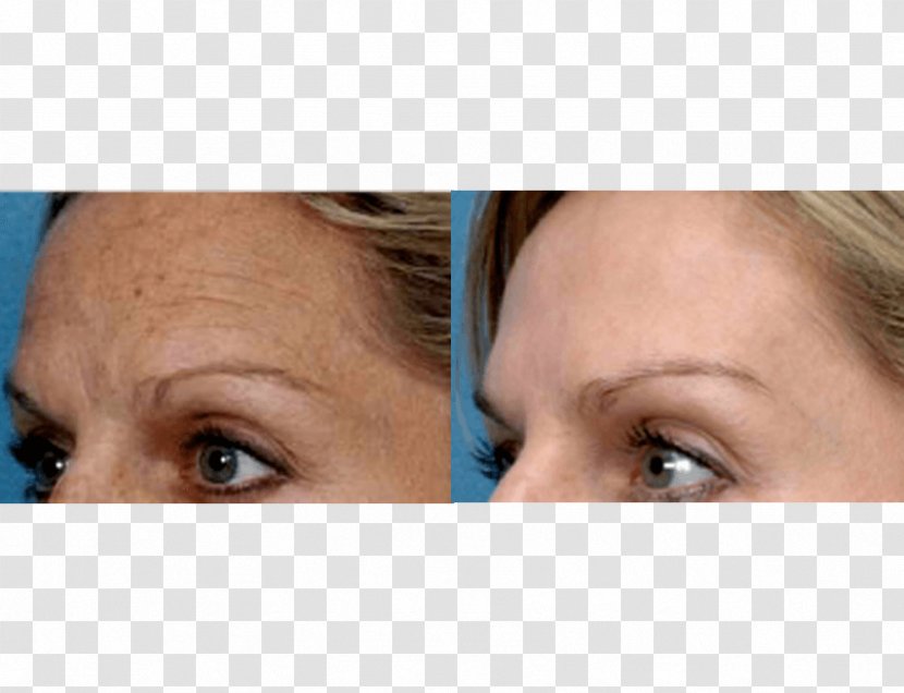 Photorejuvenation Facial Rejuvenation Collagen Induction Therapy Skin - Microdermabrasion - Wrinkle Transparent PNG
