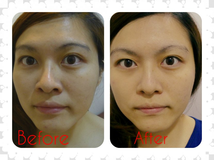 Eyebrow Cheek Chin Forehead Eyelash - Acne Scars Transparent PNG