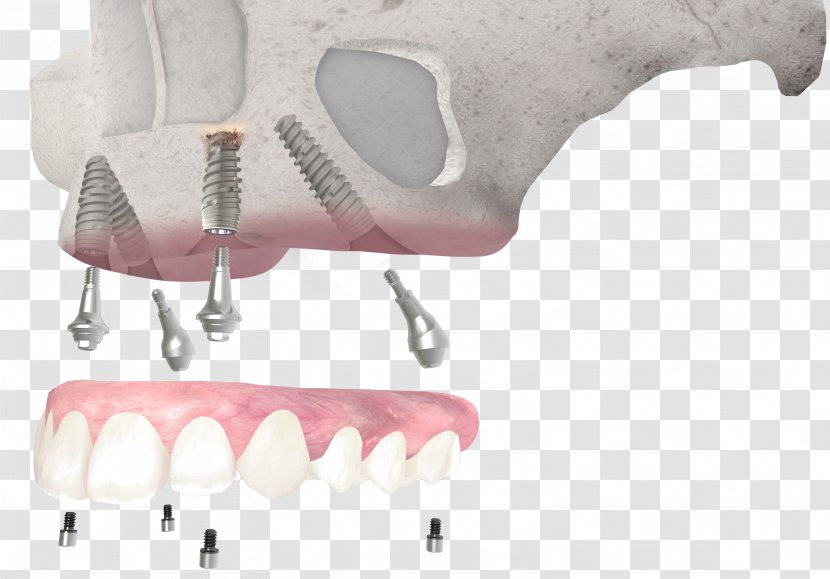 Tooth Dental Implant Dentistry All-on-4 - Osseointegration Transparent PNG