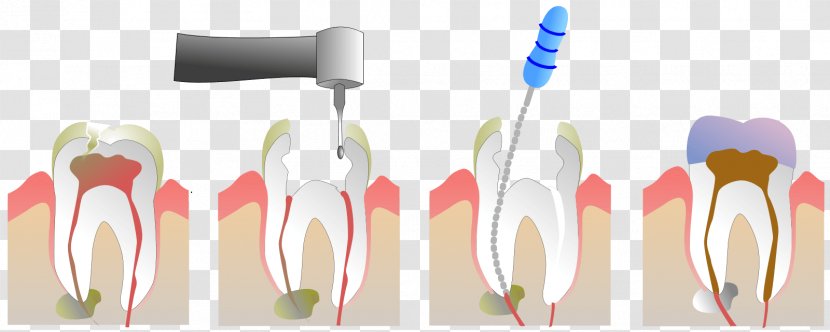 Endodontic Therapy Pulp Root Canal Dentistry - Joint - Tooth Transparent PNG