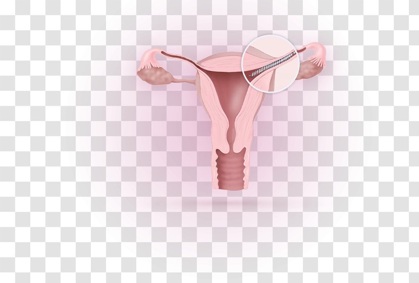 Essure Birth Control Fallopian Tube Sterilization Tubal Ligation - Pink - Woman Transparent PNG