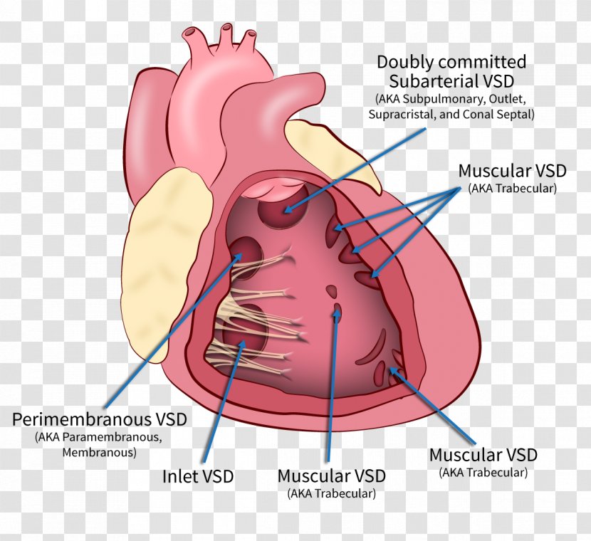 Heart Ventricular Septal Defect Interventricular Septum Ventricle - Silhouette Transparent PNG