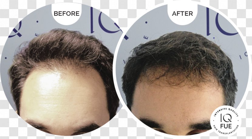 Hair Transplantation Loss Hamilton–Norwood Scale Follicular Unit Extraction - Organ Transparent PNG