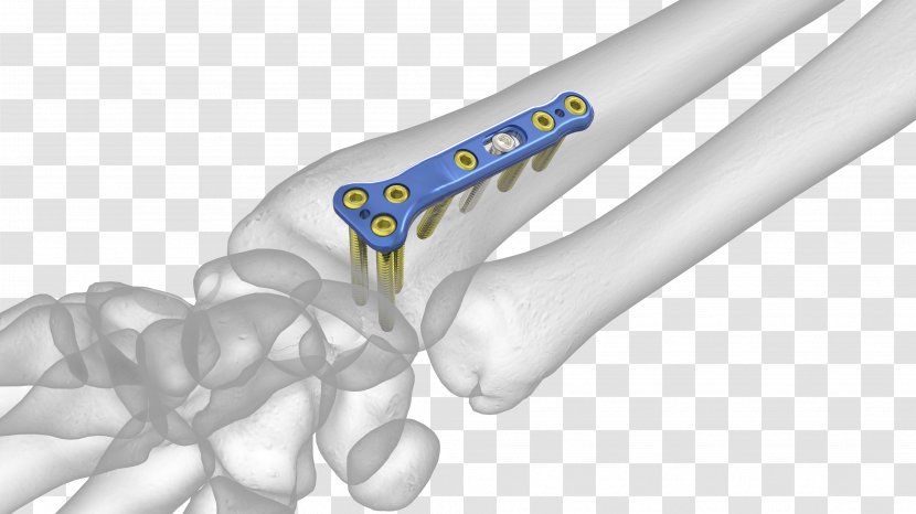 Lunate Bone Distal Radius Fracture Radial Styloid Process - Hand - Grafting Transparent PNG