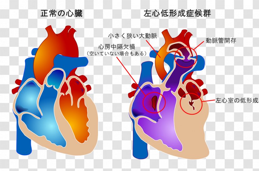 Tetralogy Of Fallot Congenital Heart Defect Blue Baby Syndrome Pentalogy - Silhouette Transparent PNG