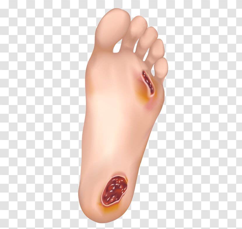 Diabetic Foot Ulcer Diabetes Mellitus Disease Podiatrist - Frame - Wound Transparent PNG