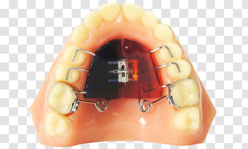 ROA - Maxilla - Ricoh Orthodontic Appliances Jaw Orthodontics Technology Quad HelixOthers Transparent PNG