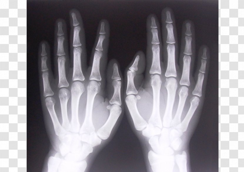 Backscatter X-ray Rheumatoid Arthritis Joint - Black And White - Bone Transparent PNG